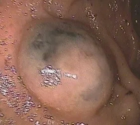 DIFFUSE GASTRIC MELANOMA