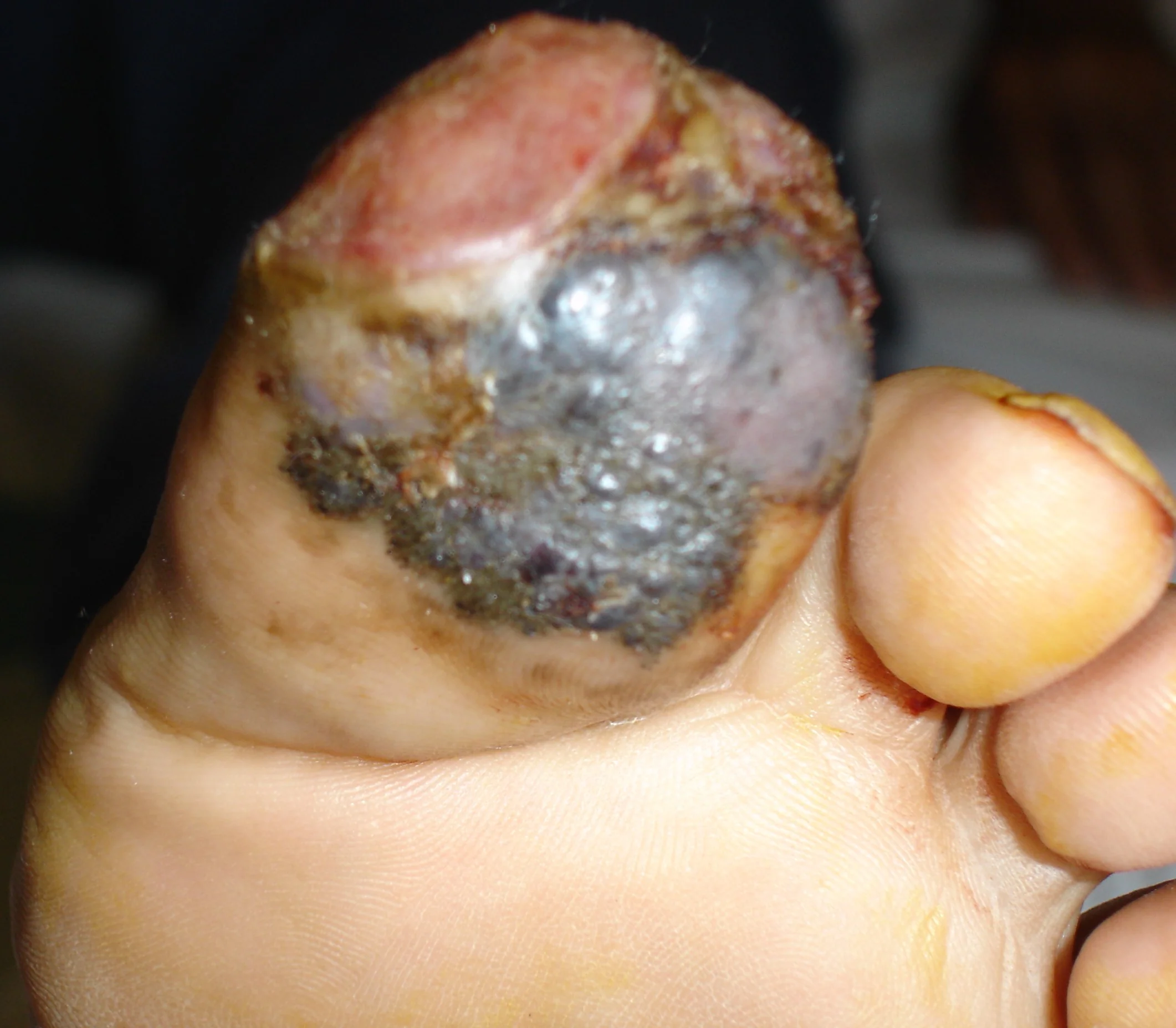 TOE MELANOMA