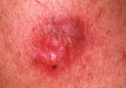 AMELANOTIC MELANOMA