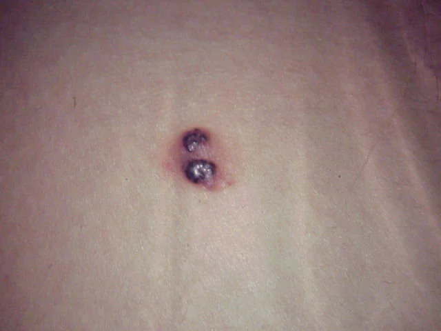 MELANOMA