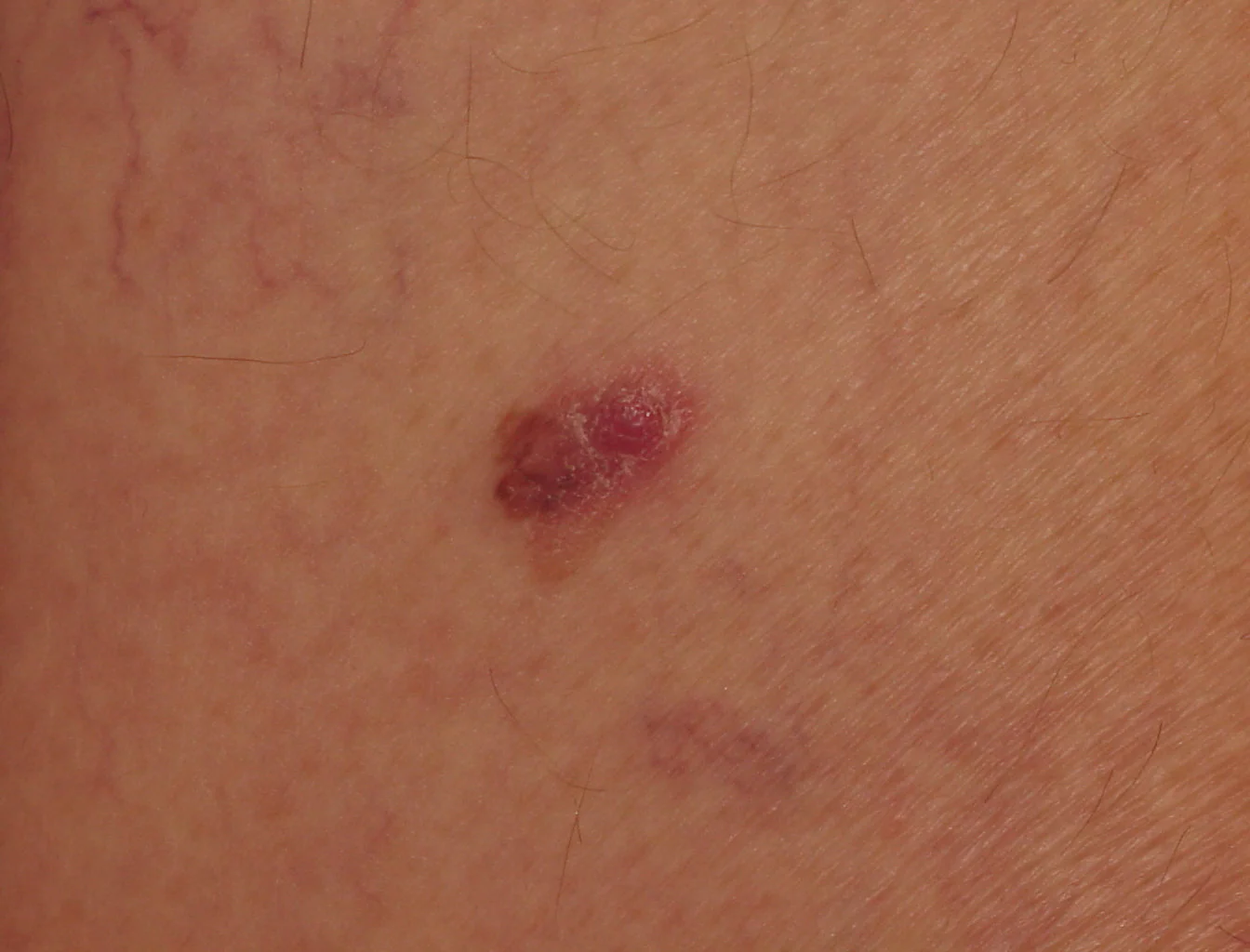 MELANOMA