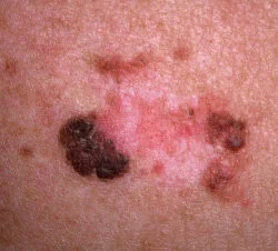 MELANOMA
