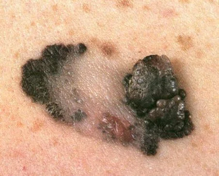 MELANOMA