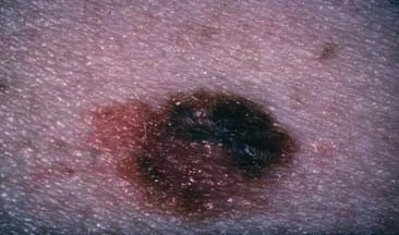 MELANOMA