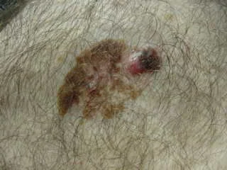 MELANOMA