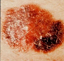 MELANOMA