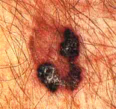 MELANOMA