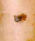 MELANOMA