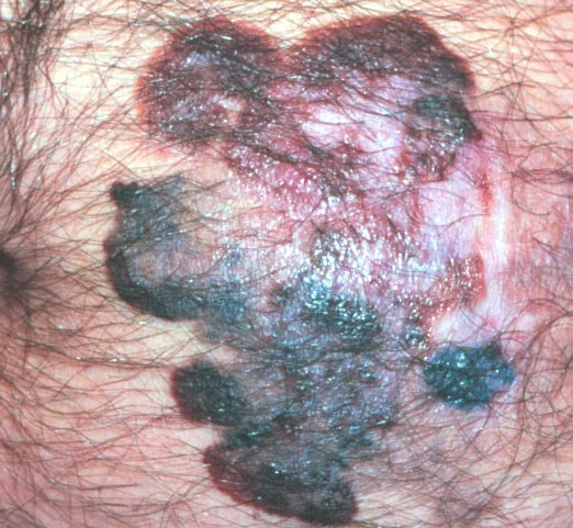 MELANOMA