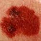 MELANOMA