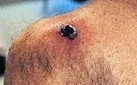 SHOULDER MELANOMA