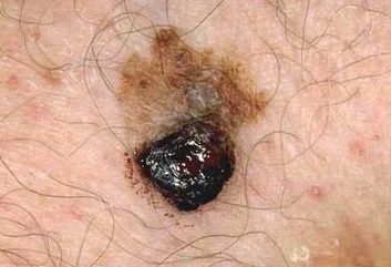 MELANOMA