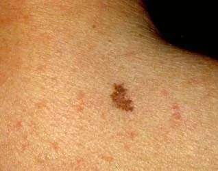 MELANOMA