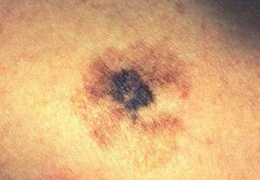 MELANOMA