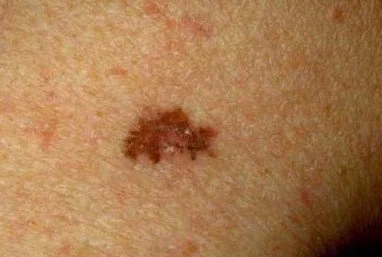 MELANOMA