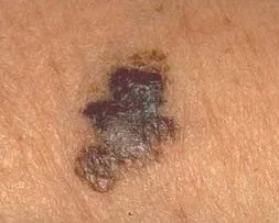 MELANOMA