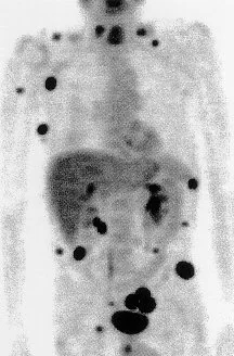 MELANOMA METASTASES