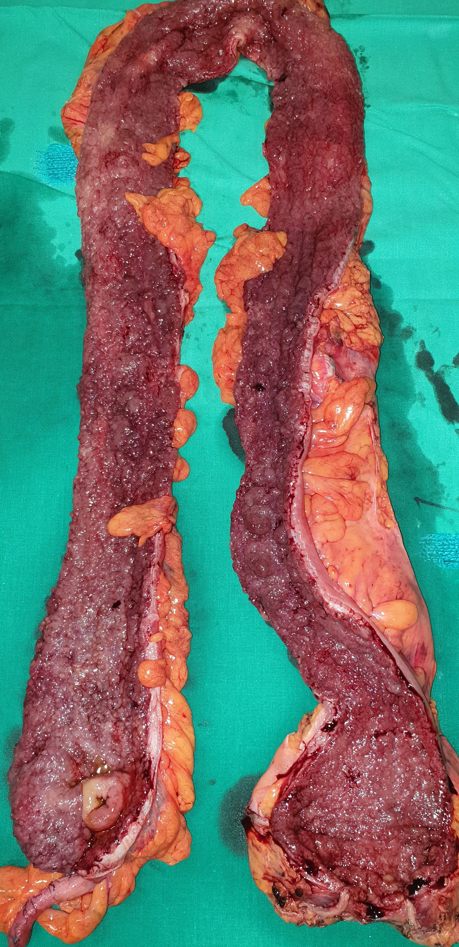 ULCERATIVE COLITIS