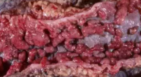 CROHN'S DISEASE