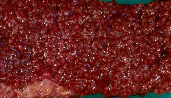 ULCERATIVE COLITIS