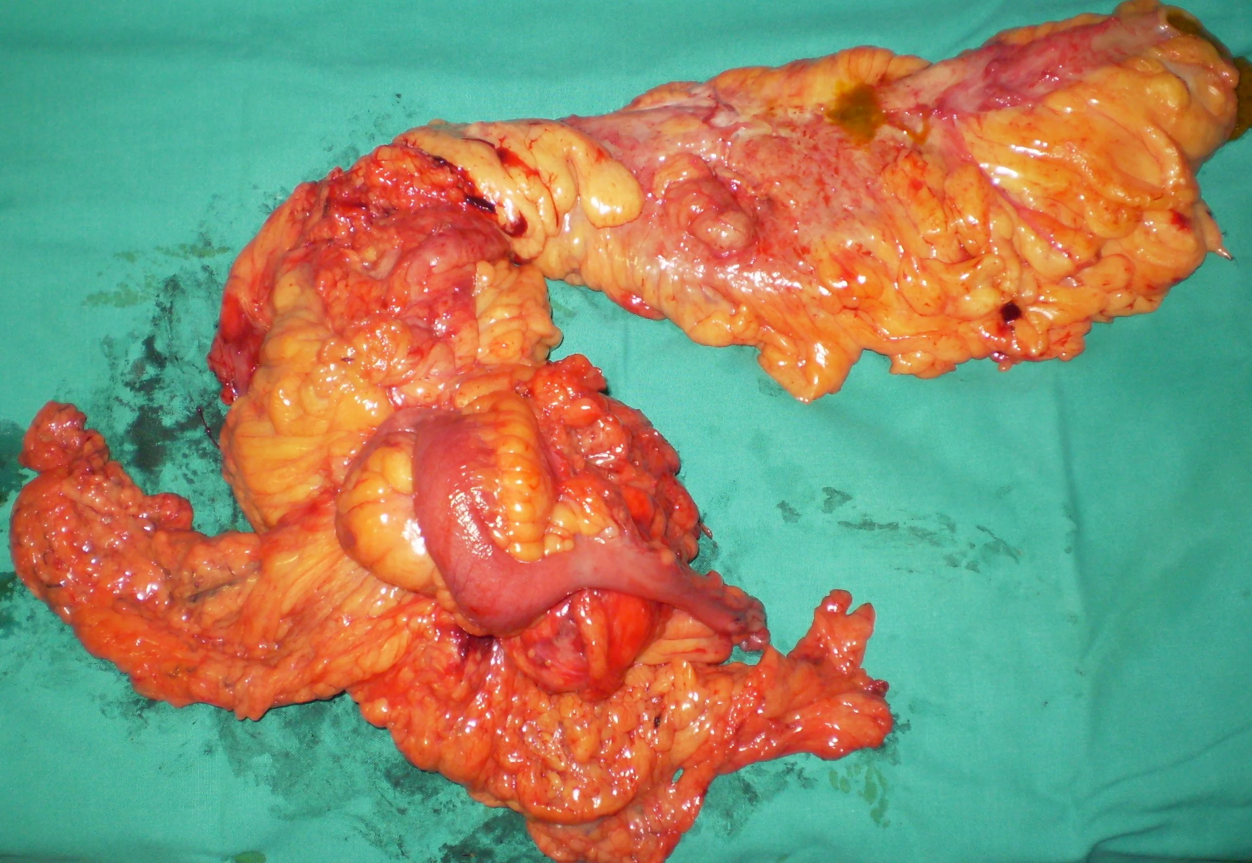 CROHN'S DISEASE - ENTEROCOLECTOMY