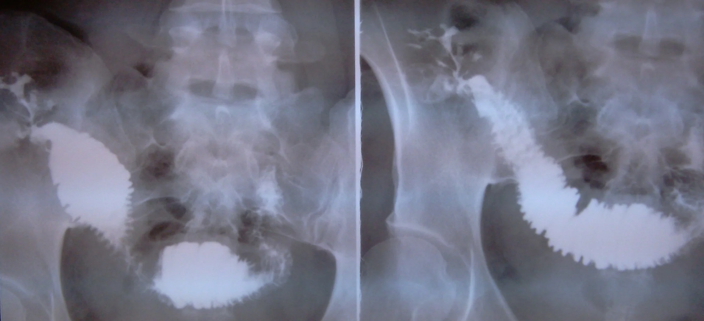 ENTEROCUTANEOUS FISTULA