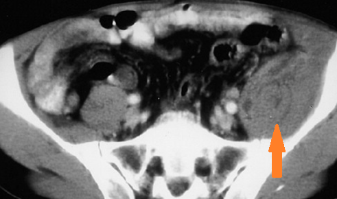 CROHN'S DISEASE - PSOAS ABSCESS
