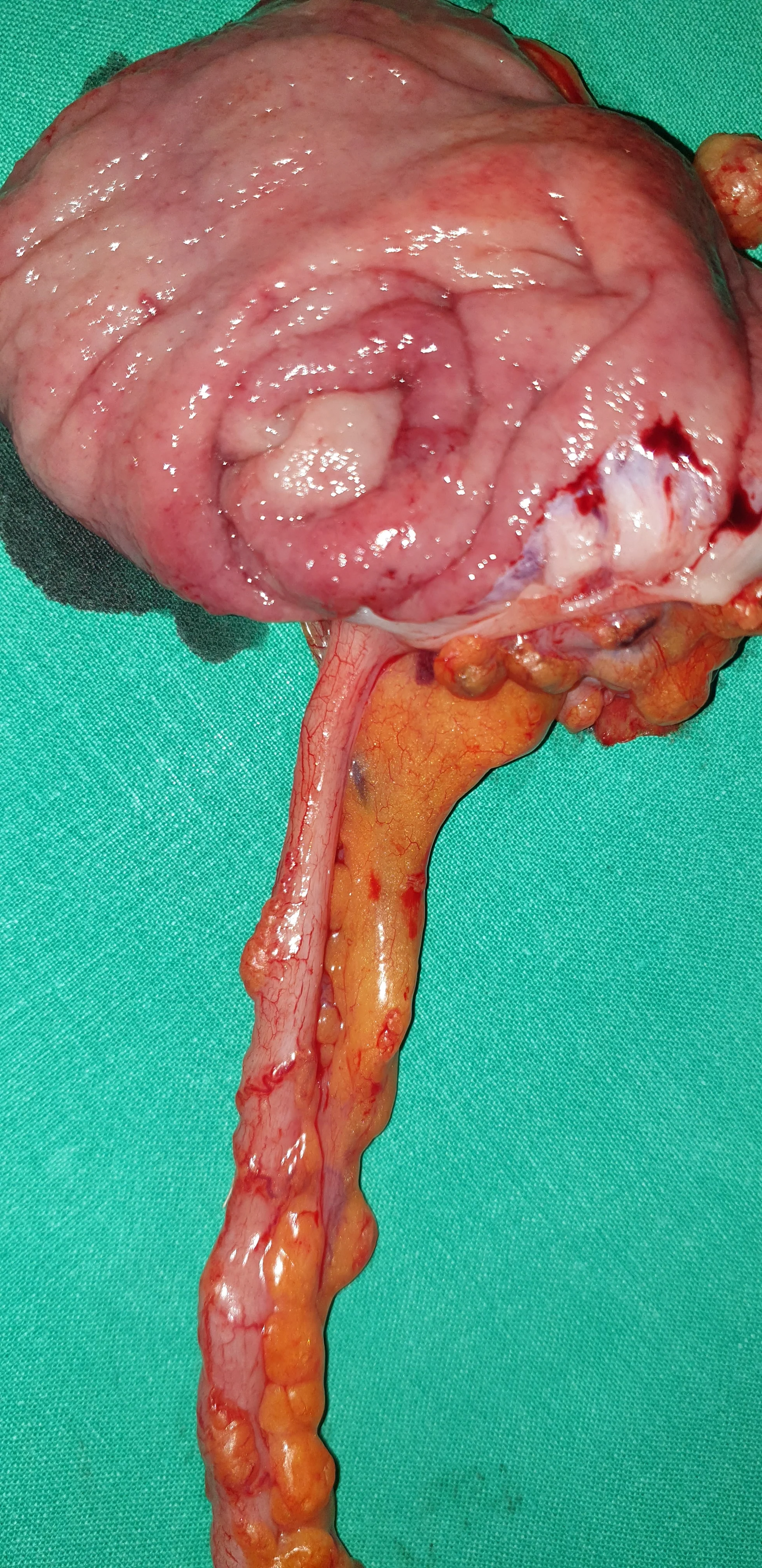CROHN'S APPENDICITIS