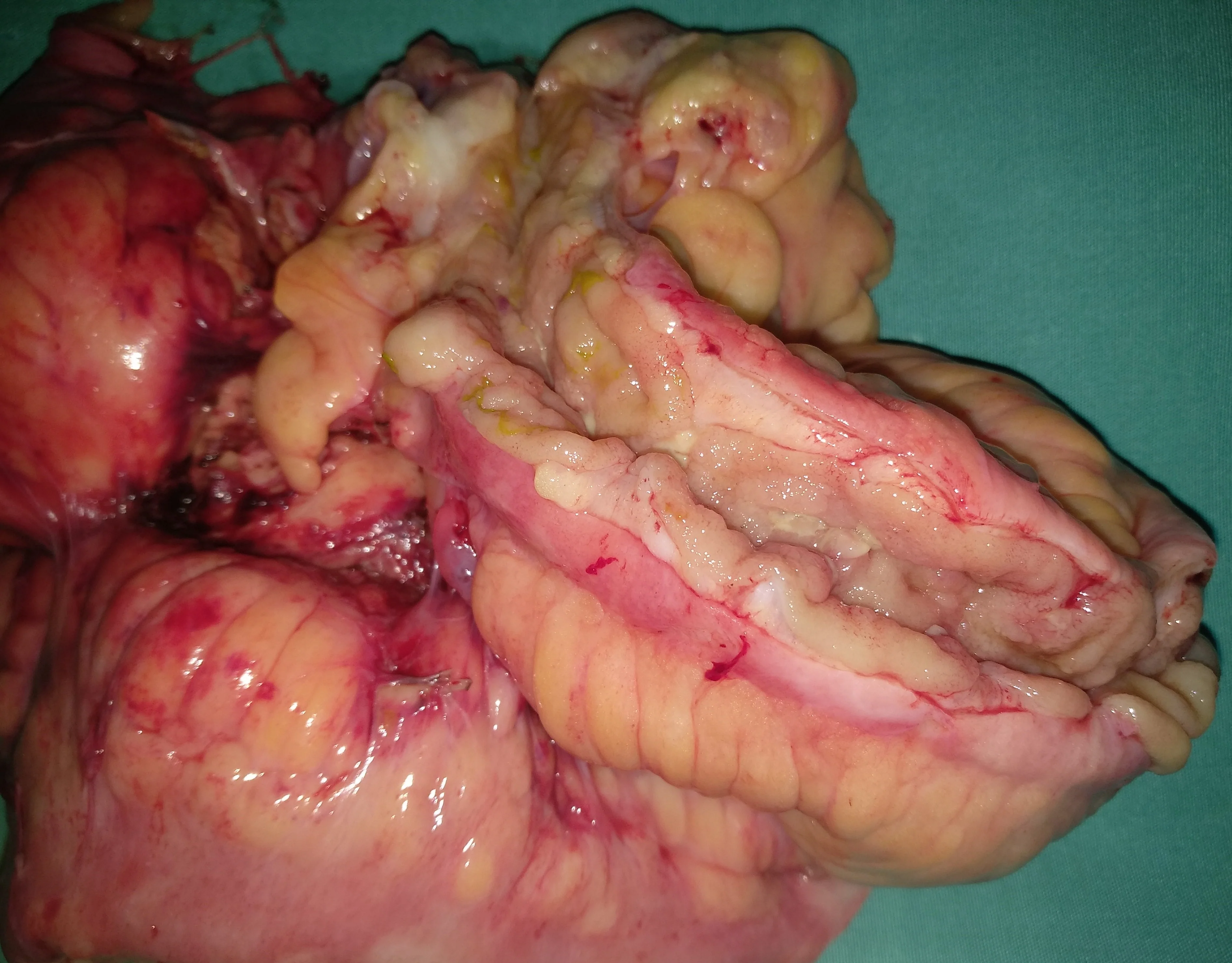 CROHN'S DISEASE - ENTERECTOMY