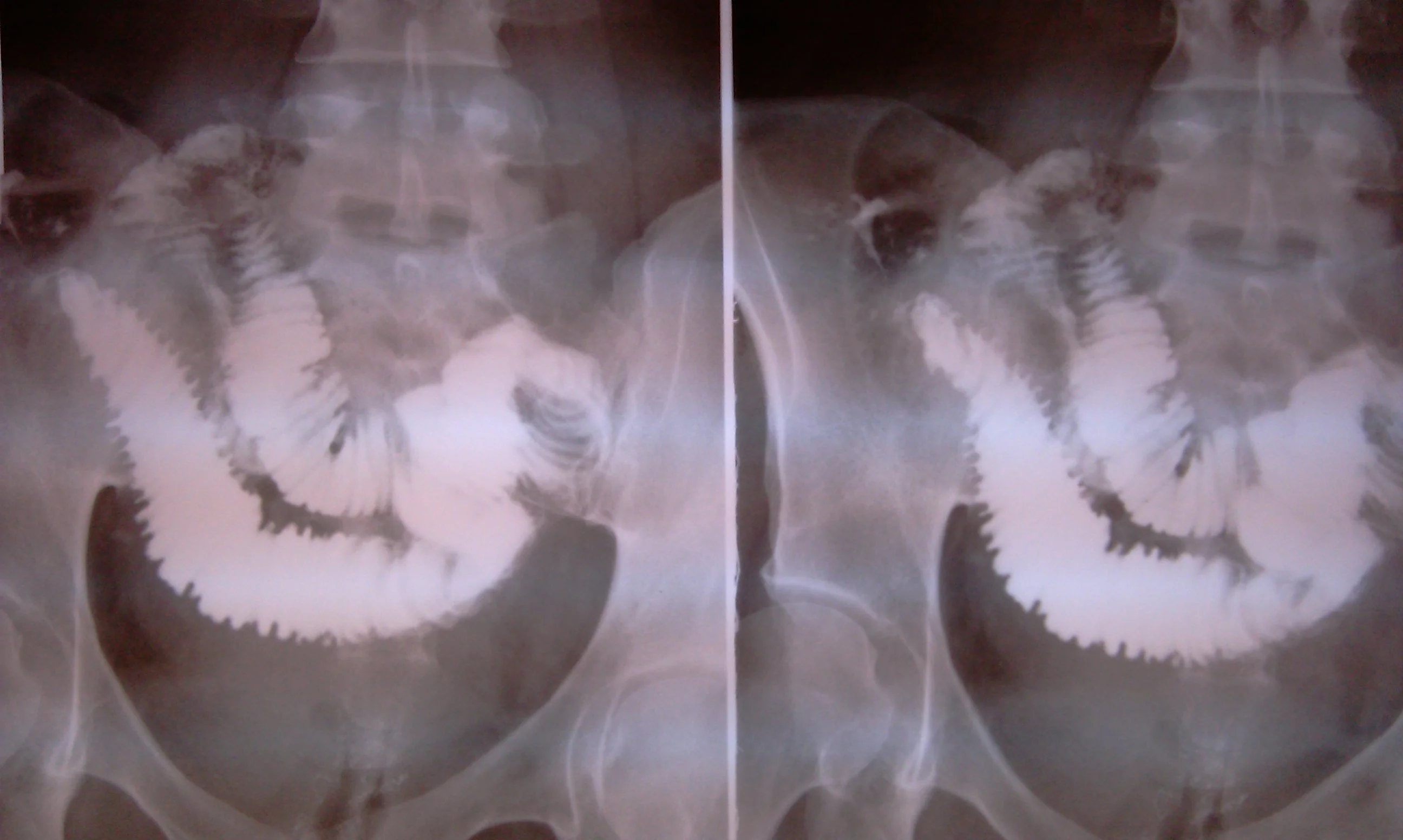 ENTEROCUTANEOUS FISTULA