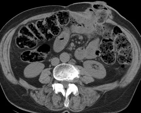 CROHN'S DISEASE - ENTEROCUTANEOUS FISTULA