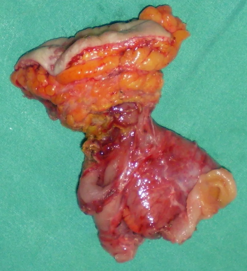 CROHN'S DISEASE - ENTEROCUTANEOUS FISTULA