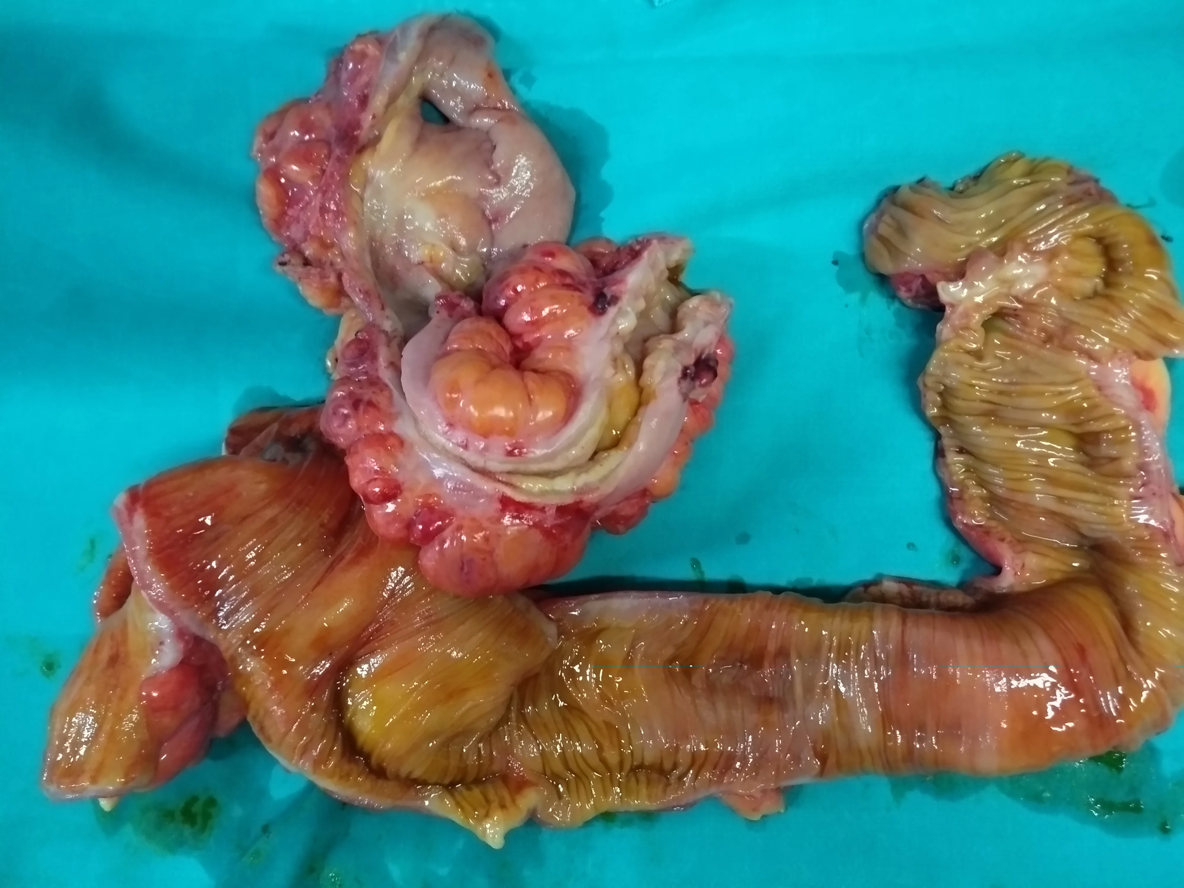 CROHN'S DISEASE - ENTEROCOLECTOMY