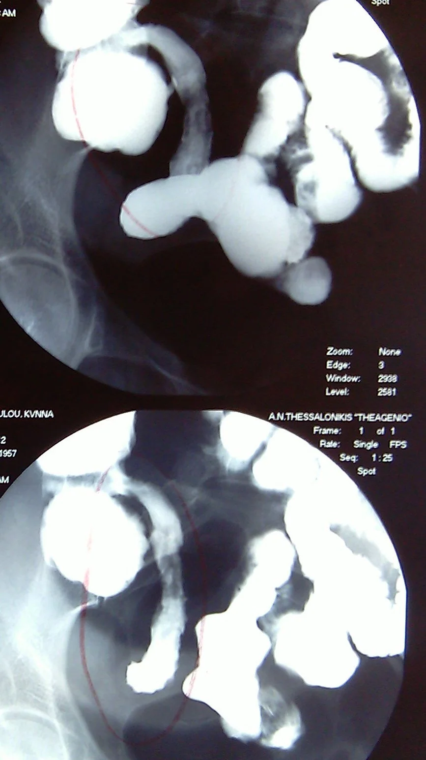 CROHN'S DISEASE - SMALL BOWEL BARIUM MEAL