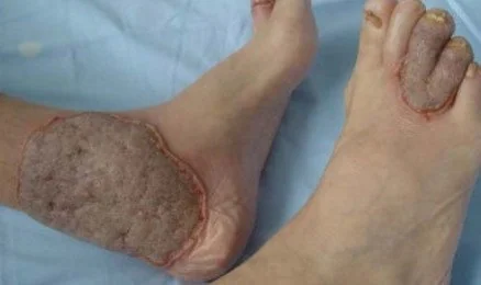 ULCERATIVE COLITIS - PYODERMA VEGETANS