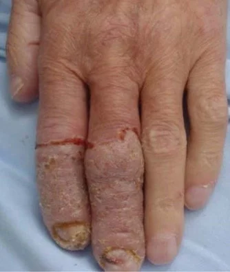 ULCERATIVE COLITIS - PYODERMA VEGETANS