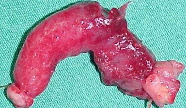 APPENDECTOMY - CROHN'S DISEASE