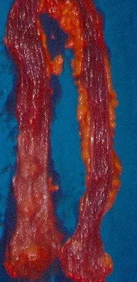 ULCERATIVE COLITIS
