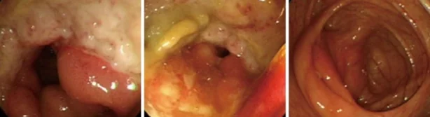 BEHCET'S DISEASE
