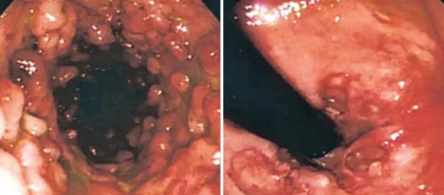 BEHCET'S DISEASE