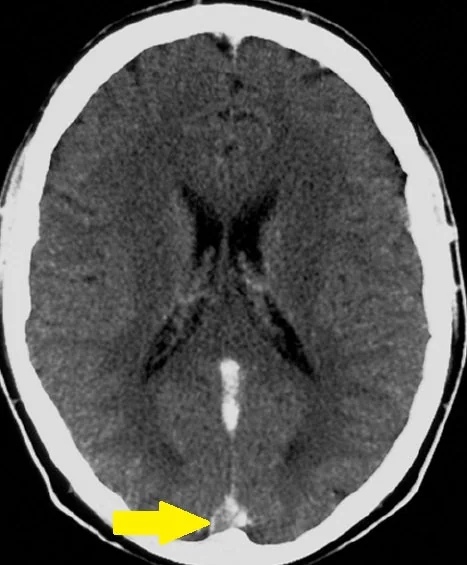 BEHCET'S DISEASE - CEREBRAL VENOUS THROMBOSIS