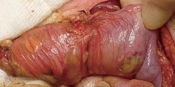 BEHCET'S DISEASE - COLONIC PERFORATION