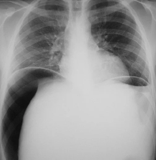 BEHCET'S DISEASE - COLONIC PERFORATION