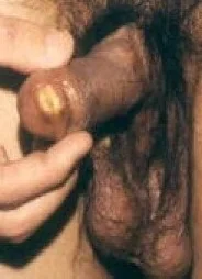 BEHCET'S DISEASE
