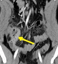 BEHCET'S DISEASE