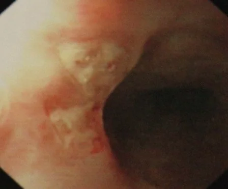 BEHCET'S DISEASE