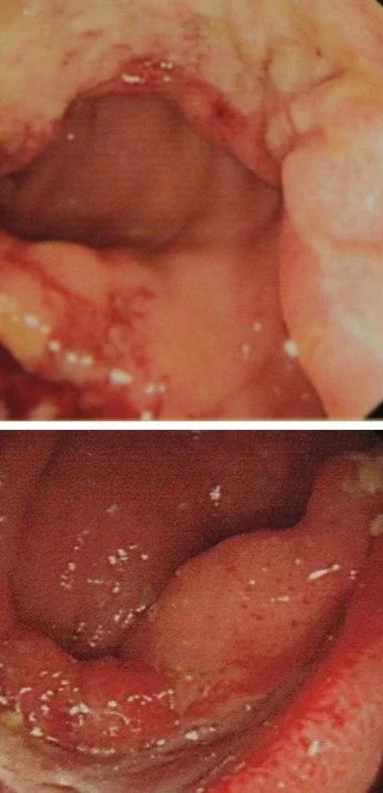 BEHCET'S DISEASE