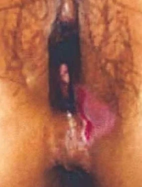 BEHCET'S DISEASE