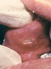 BEHCET'S DISEASE
