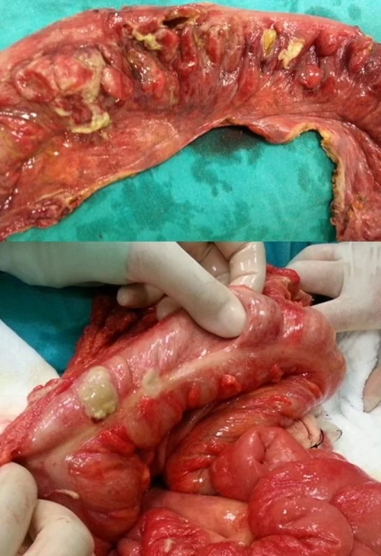 BEHCET DISEASE + BUDD CHIARI SYNDROME
